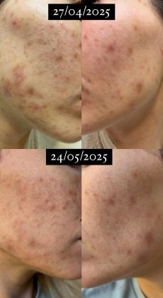 safran bienfaits peau réduit imperfections anti acné sérum visage au safran safran bienfaits peau réduit imperfections anti acné sérum visage au safran